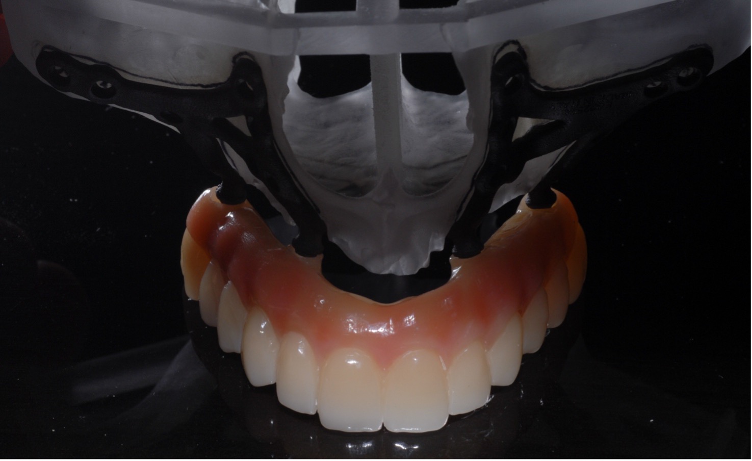 Griglia sottoperiostale Eaglegrid per assenza di osso a sostegno di toronto per carico immediato in centro specializzato di implantologia Trecase, Na